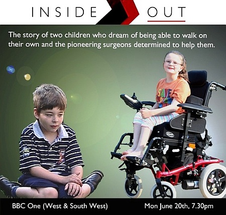 BBC Inside Out West documentary on SDR surgery